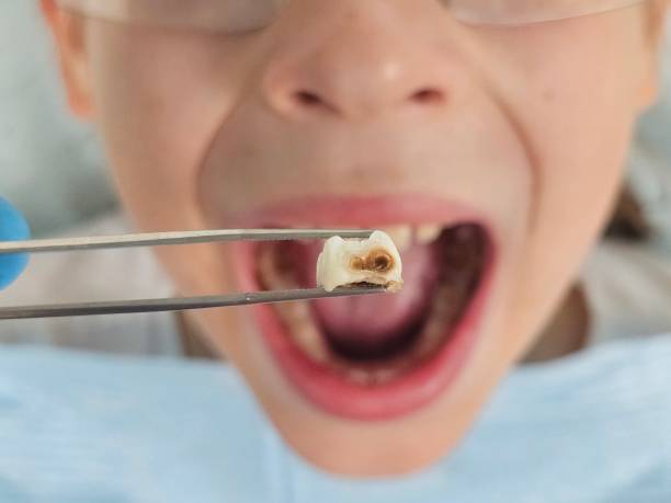 Best Emergency Dentist for Knocked-Out Tooth in Lake Isabella, MI